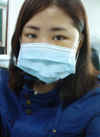 在北京炫美磨了下颌角 恢复纪实分享