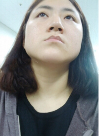 在北京炫美磨了下颌角 恢复纪实分享