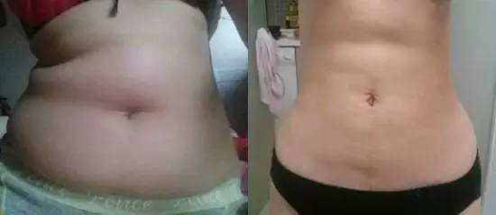 北京炫美腹部吸脂术后 穿衣服更有型了！