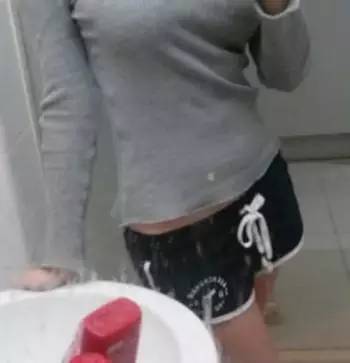 北京炫美腹部吸脂术后 穿衣服更有型了！