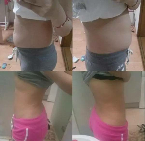 北京炫美腹部吸脂术后 穿衣服更有型了！