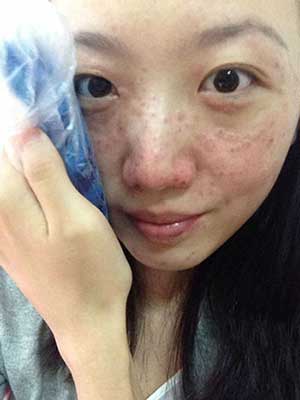 长春中研激光祛斑 让我告别了麻子脸