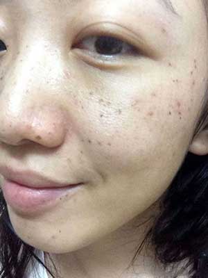 长春中研激光祛斑 让我告别了麻子脸