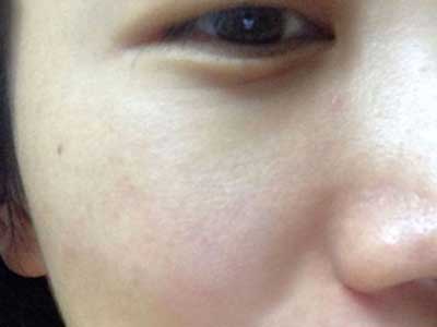 长春中研激光祛斑 让我告别了麻子脸