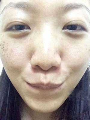 长春中研激光祛斑 让我告别了麻子脸