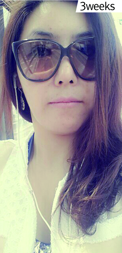 电波l皮除皱让我弹走小皱纹 果真的很不错