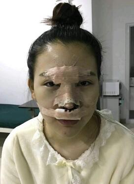 隆鼻整形术后1-7天的照片 长春中研综合隆鼻一个月了