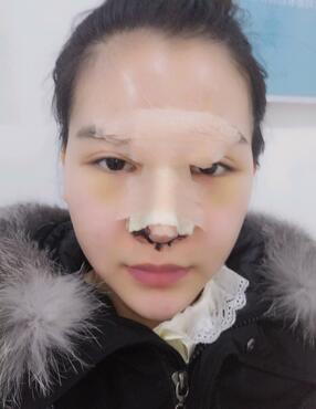 隆鼻整形术后1-7天的照片 长春中研综合隆鼻一个月了