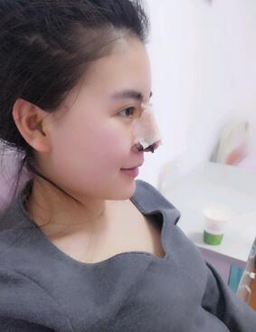 隆鼻整形术后1-7天的照片 长春中研综合隆鼻一个月了