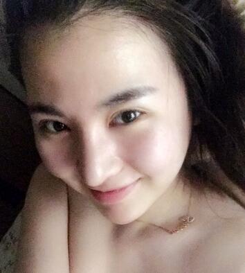 隆鼻整形术后1-7天的照片 长春中研综合隆鼻一个月了