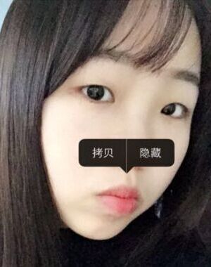 切开双眼皮让我拥有自然的双眼皮