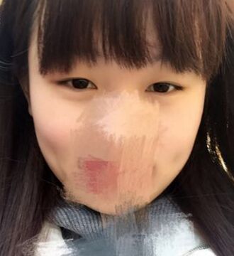 为了摆脱内双的小眼睛做了切开双眼皮