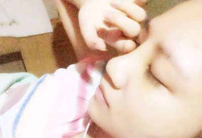 假体隆鼻15天后恢复果 杭州时光做的~