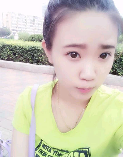 假体隆鼻15天后恢复果 杭州时光做的~