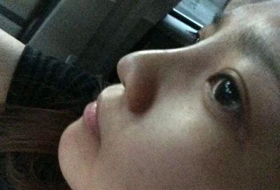 假体隆鼻15天后恢复果 杭州时光做的~