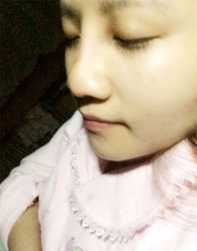 假体隆鼻15天后恢复果 杭州时光做的~