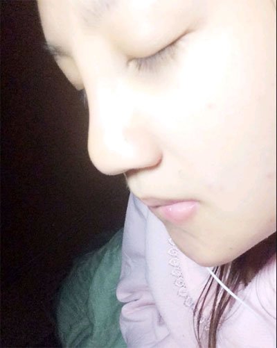 假体隆鼻15天后恢复果 杭州时光做的~