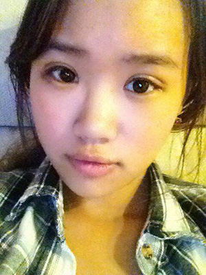 纳米x雕双眼皮15天了~ 我恢复的算快吗