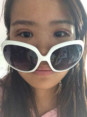 纳米x雕双眼皮15天了~ 我恢复的算快吗