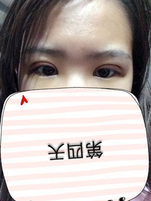 纳米x雕双眼皮15天了~ 我恢复的算快吗