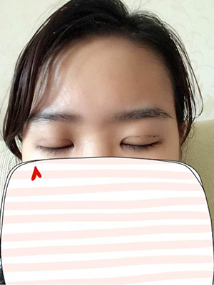 纳米x雕双眼皮15天了~ 我恢复的算快吗