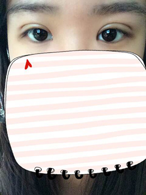 纳米x雕双眼皮15天了~ 我恢复的算快吗