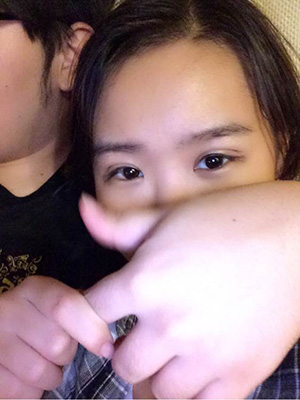 纳米x雕双眼皮15天了~ 我恢复的算快吗