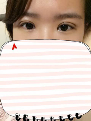 纳米x雕双眼皮15天了~ 我恢复的算快吗