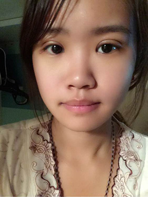 纳米x雕双眼皮15天了~ 我恢复的算快吗