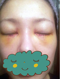 杭州时光激光去眼袋1个月了