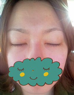 杭州时光激光去眼袋1个月了