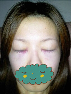 杭州时光激光去眼袋1个月了