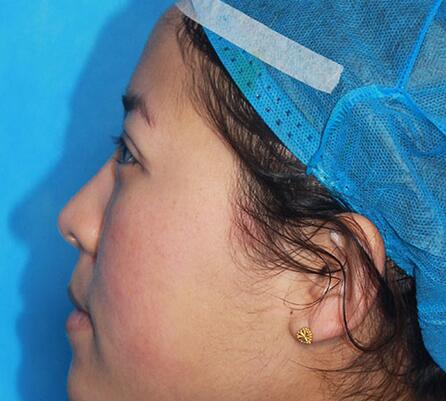 双眼皮手术让我单眼皮变双眼皮就是这么简单