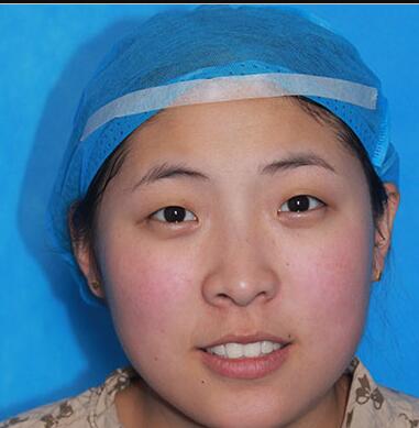 双眼皮手术让我单眼皮变双眼皮就是这么简单