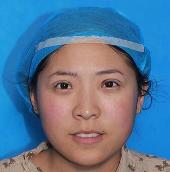 双眼皮手术让我单眼皮变双眼皮就是这么简单