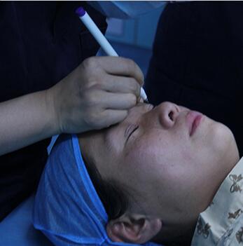 双眼皮手术让我单眼皮变双眼皮就是这么简单