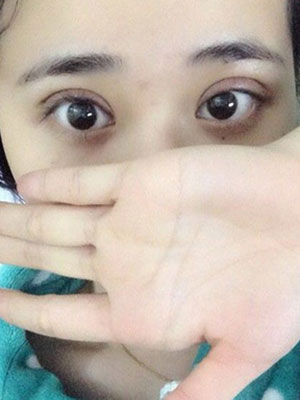 北京常好丽格割双眼皮一周啦~