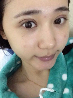 北京常好丽格割双眼皮一周啦~