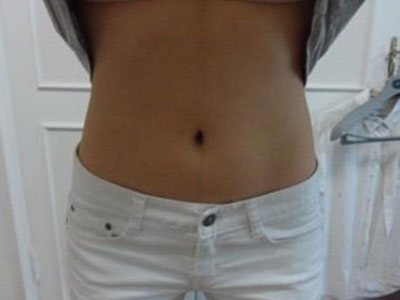 北京常好丽格腰腹吸脂后20天的感受 恢复日记来咯~