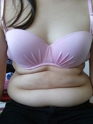 北京常好丽格腰腹吸脂后20天的感受 恢复日记来咯~