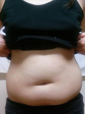 北京常好丽格腰腹吸脂后20天的感受 恢复日记来咯~