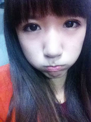 北北京常好丽格三点定位双眼皮恢复一个月经历