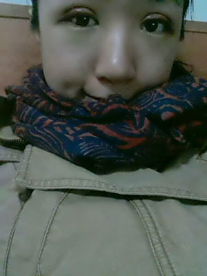 北北京常好丽格三点定位双眼皮恢复一个月经历