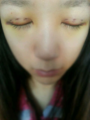 北北京常好丽格三点定位双眼皮恢复一个月经历