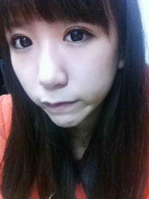 北北京常好丽格三点定位双眼皮恢复一个月经历