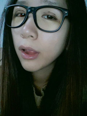 北北京常好丽格三点定位双眼皮恢复一个月经历