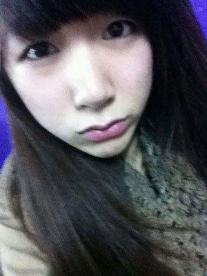 北北京常好丽格三点定位双眼皮恢复一个月经历