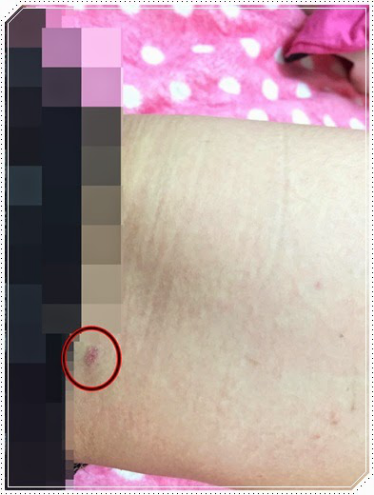 自体脂肪丰胸让我的小平胸变成大豪乳