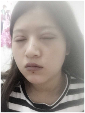 广州丽尚做的全切开双眼 变身混血儿