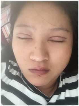 广州丽尚做的全切开双眼 变身混血儿
